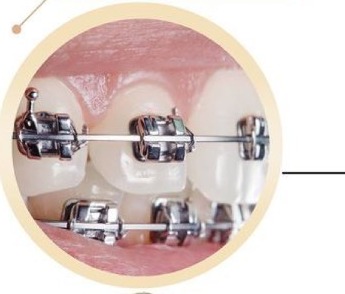 Aparelho Ortodôntico - Telles OralFace